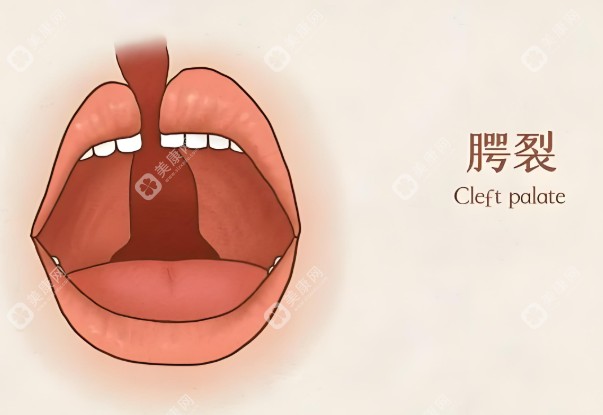 国内唇腭裂手术价格收费表www.slzxedu.com