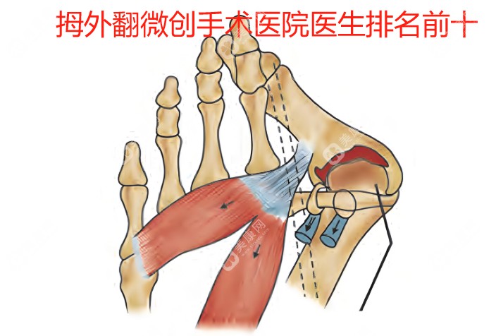 2025国内拇外翻微创手术医院医生排名前十(疼痛感轻,不缝合不住院,术后行走自如)