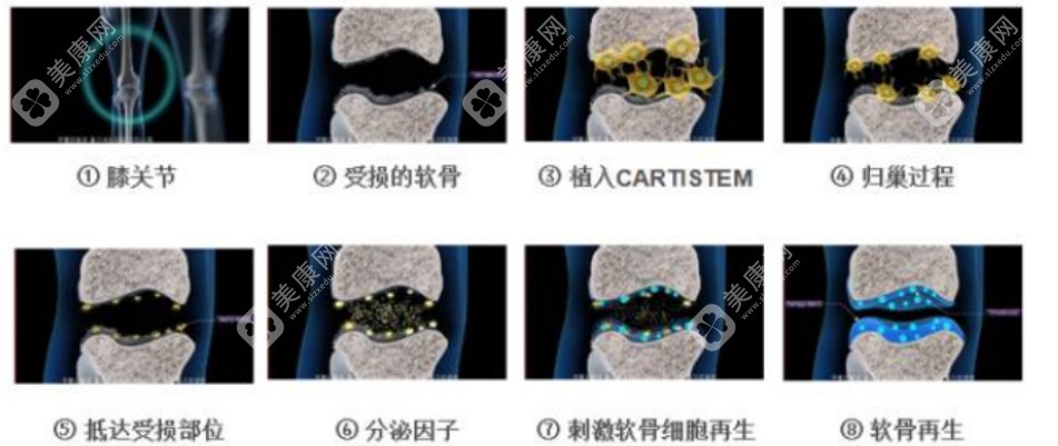 Cartistem手术在韩国可以注射