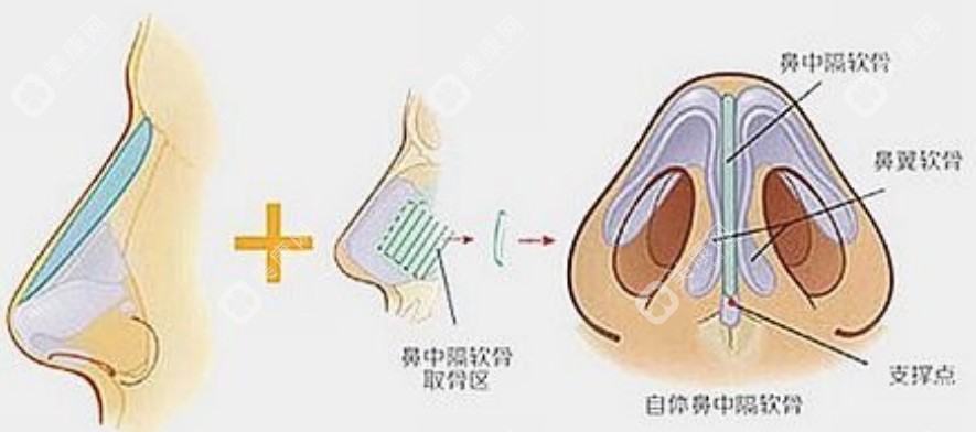 重庆时光整形美容医院隆鼻手术示意图