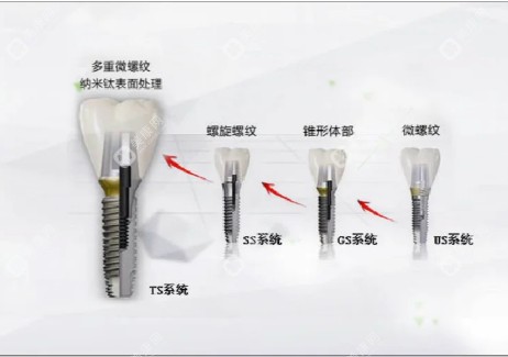 韩国奥齿泰种植体