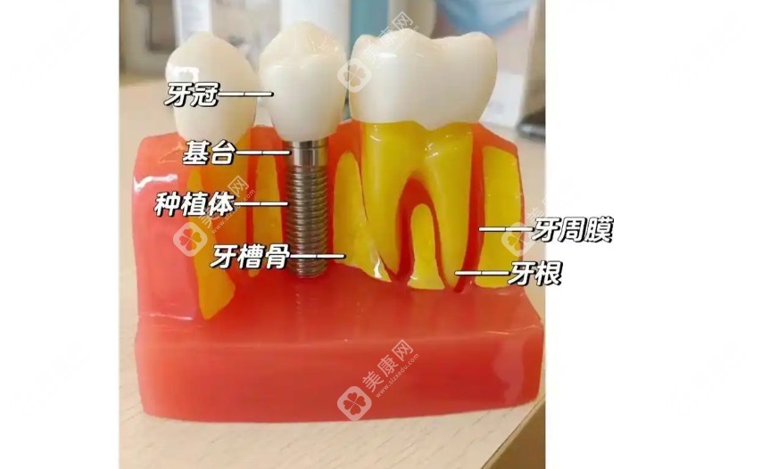 种植牙品牌选择攻略www.slzxedu.com