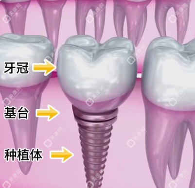 种植牙结构