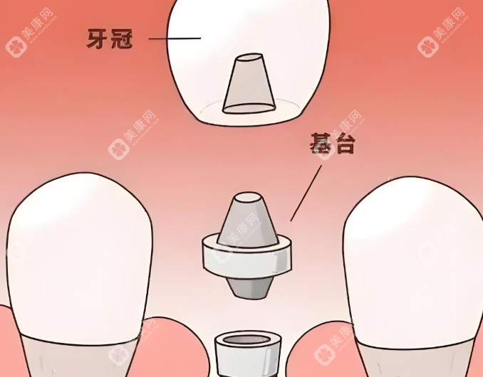 种植牙结构