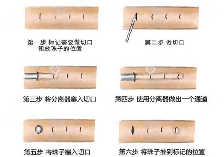 男士埋珠手术费用图片曝光!包含埋4颗、8颗、18颗体珠价格(亲身体验埋珠2年后成效仍显著)