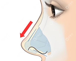 鼻整形手术