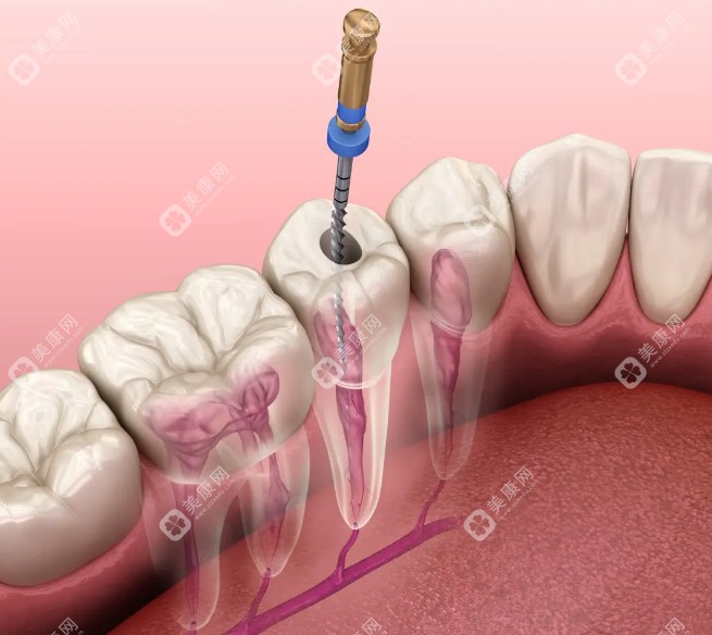 【医生不会说的根管秘密】今日揭开根管治疗鲜为人知的内幕与无可比拟的优势