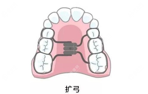 扩弓矫正前后脸型对比:脸颊/下颌/鼻唇等可能会有轻微变化