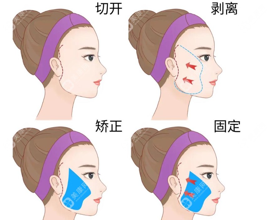 袁强拉皮在哪面诊?我在北京朝阳区育慧北路的北京联合丽格面诊袁强,预约挂号3分钟搞定！