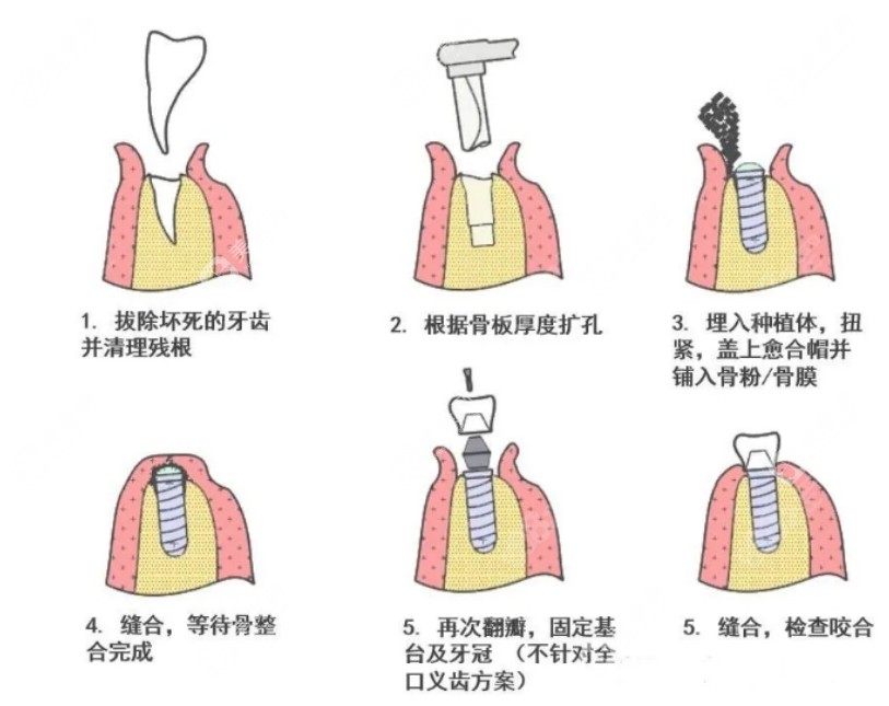 大家千万不要种植牙！揭秘良心牙医为什么不建议种植牙？