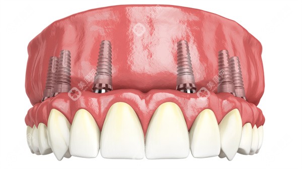 重庆口腔医院半口、全口种植牙价格