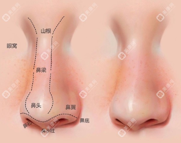 蒜头鼻整形需要多少钱?今日市场均价5000+,排名前十的医院技术好失败概率低