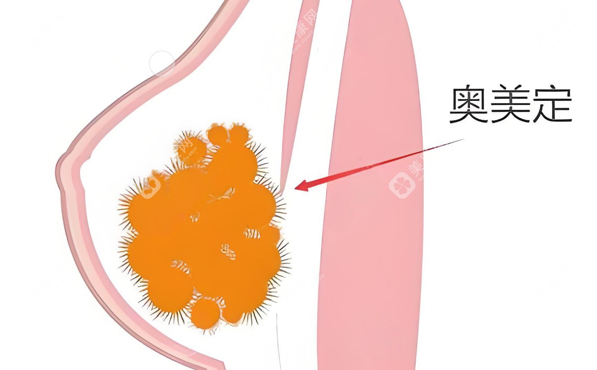 上海奥美定取出真实例子