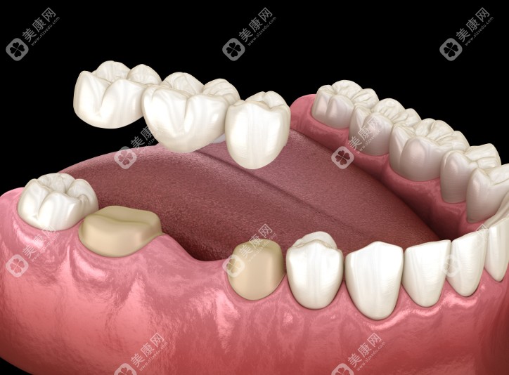 韶关镶牙材质选择 韶关镶牙材质选择
