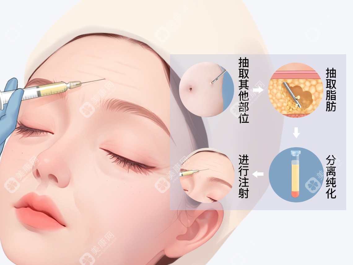 任学会吸脂价格高吗