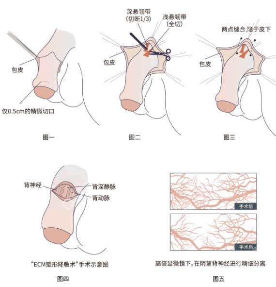 李世荣做一次延长手术多少钱
