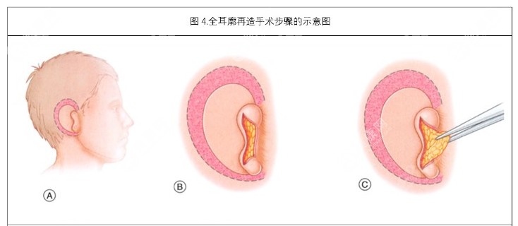 2025北京耳再造醫(yī)院排行榜