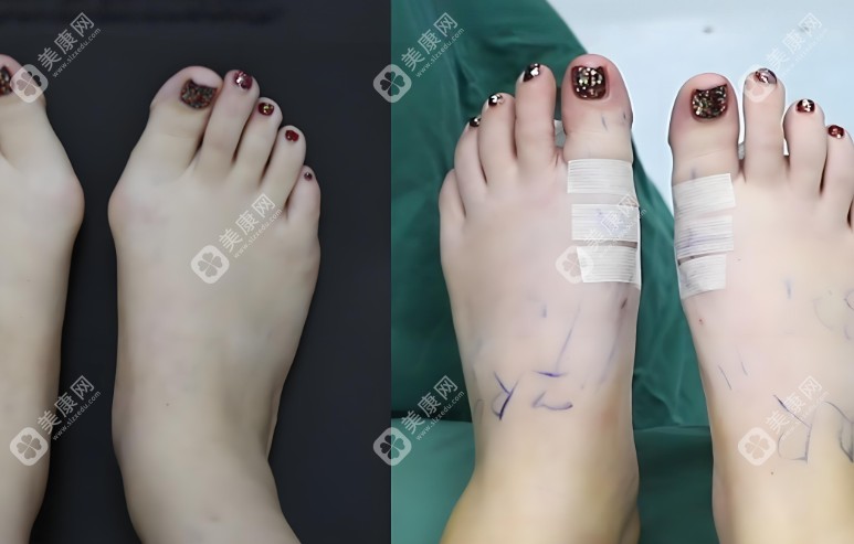 做大腳骨矯正