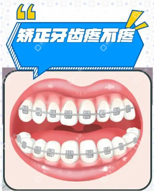 北京牙齒矯正性價比推薦