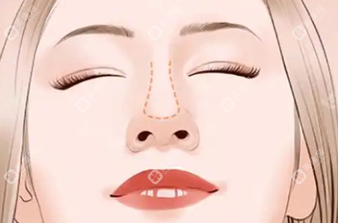 王晓健做鼻子怎么样