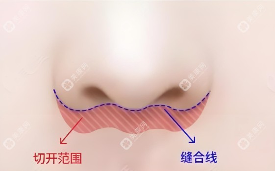 王晓健人中缩短术怎么样