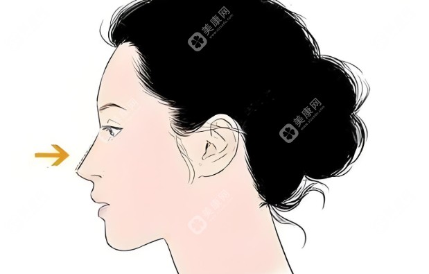鼻整形www.kangershun.cn