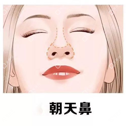 曹海峰医生在南京的口碑怎么样？鼻修复/鼻头鼻翼缩小实例刷屏，网友：这成效绝了！