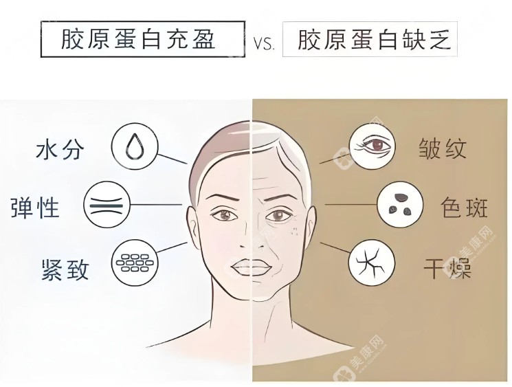 膠原蛋白注射