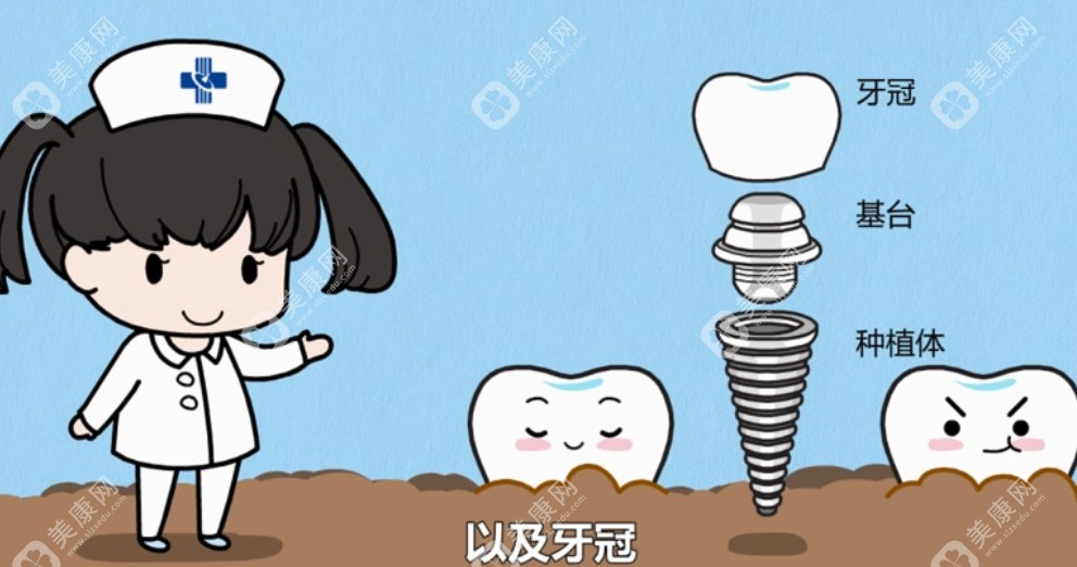 可恩口腔种植牙示意圖