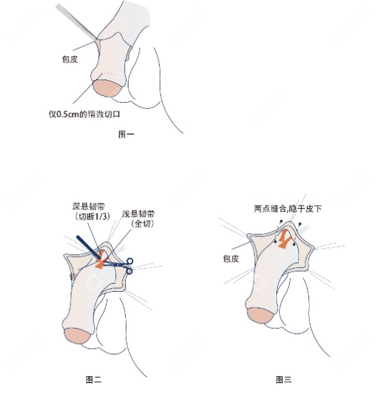 重庆李世荣做男性生殖器隐痕阴茎延长术优势