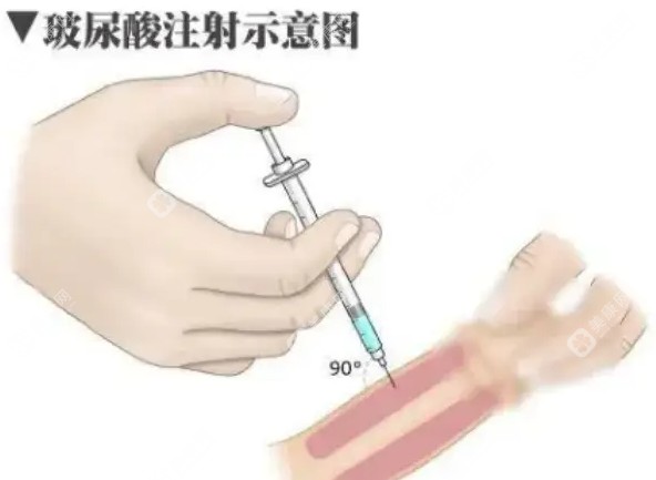 男性玻尿酸阴茎注射增大增粗技术靠谱吗