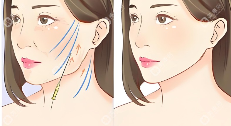 面部提升抗衰