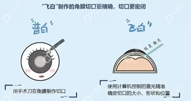 飞秒白内障