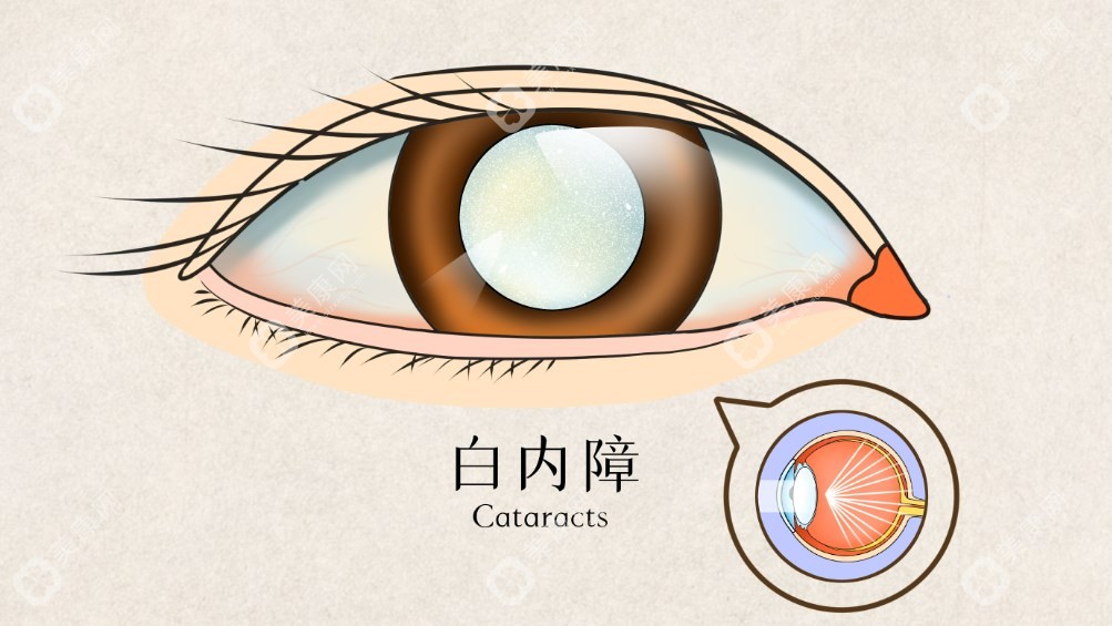 白内障手术
