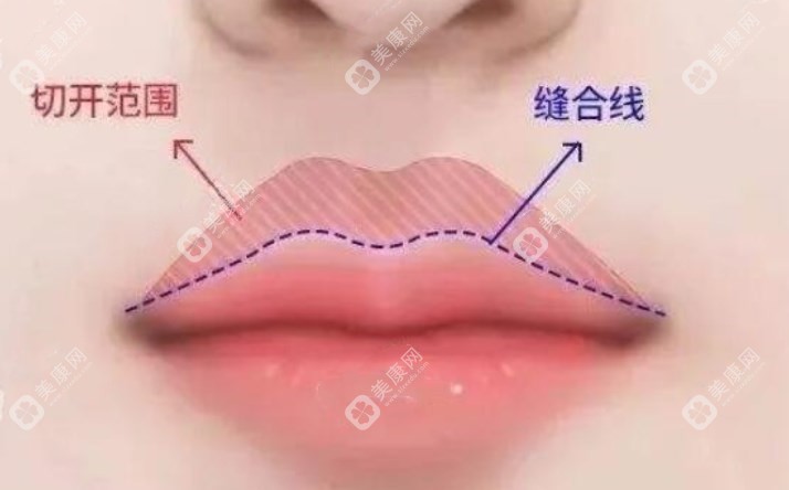 深圳胡俊杰医生个人资料简介：15年整形经验，人中缩短术8800元起