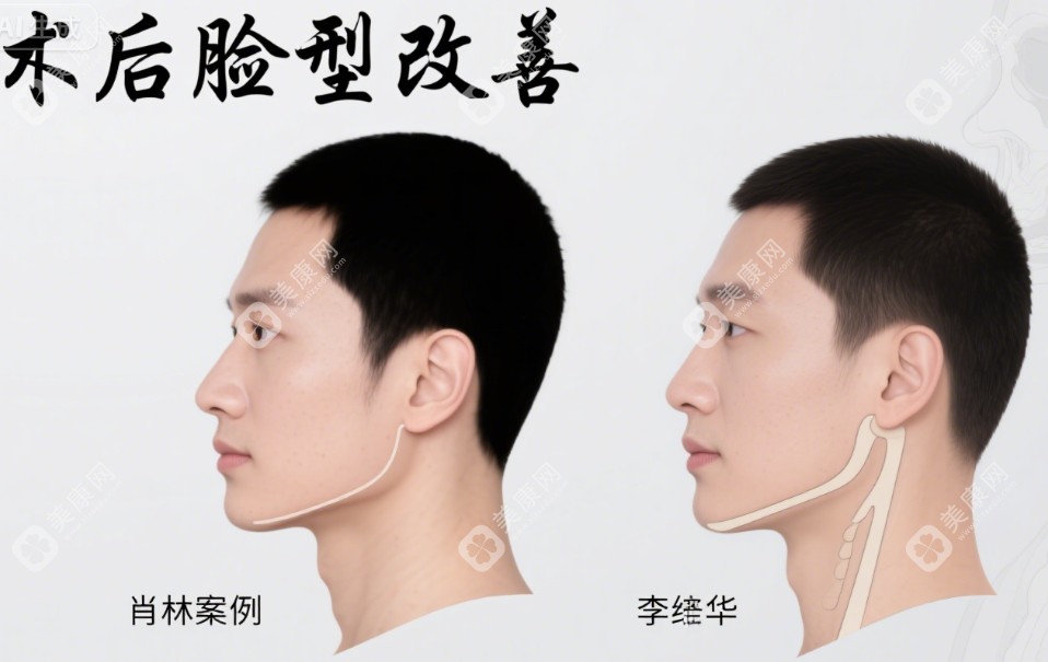 重庆肖林和成都李继华正颌手术 优势