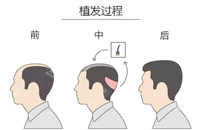 植发