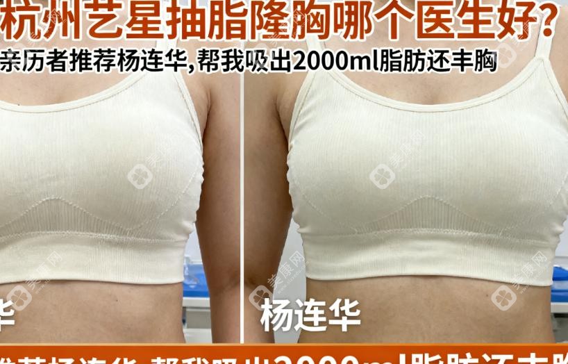 杭州藝星抽脂隆胸哪個(gè)醫(yī)生好?親歷者推薦楊連華,幫我吸出2000ml脂肪還豐胸