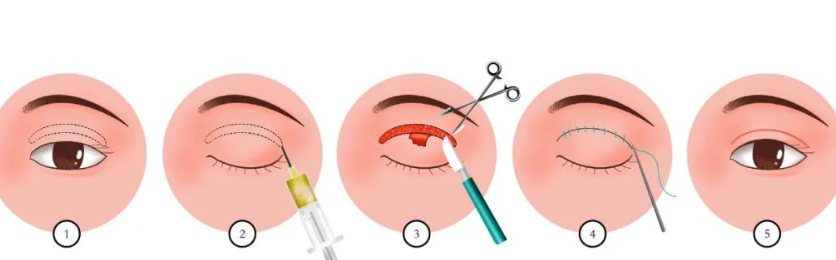 长沙唐永丰医生做的双眼皮修复怎么样?高端技术,精细操作