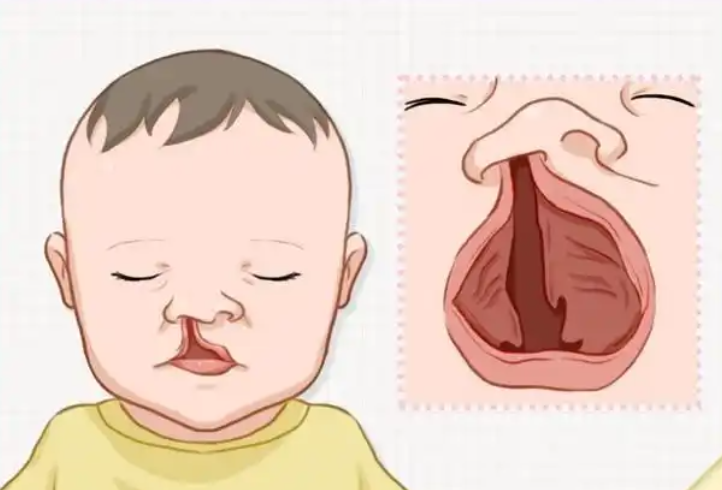 兔唇二次修复后多久可以见效？一般术后10 - 15天初见成效 选正规医院技术更靠谱一些