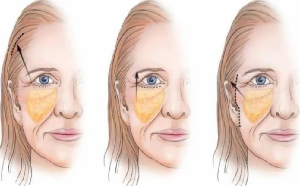 王易彬做面部提升不用愁