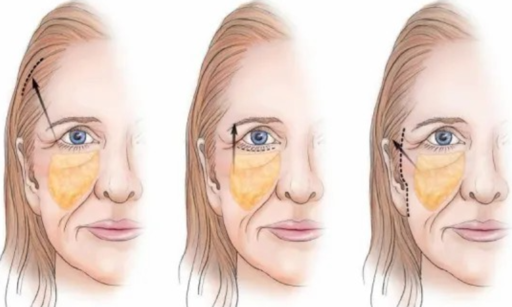 王易彬面部微整提升的收费价格