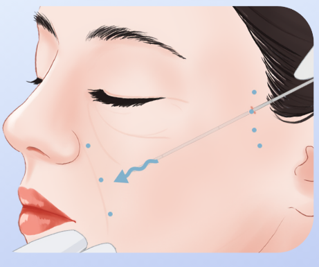 王易彬面部微整提升的收费价格