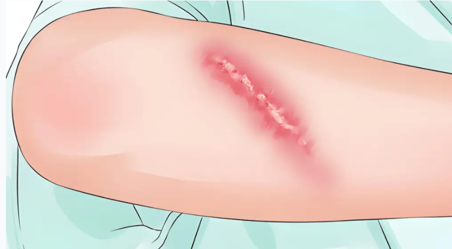 南京疤痕疙瘩醫(yī)院排名里，這3家各有“專攻”