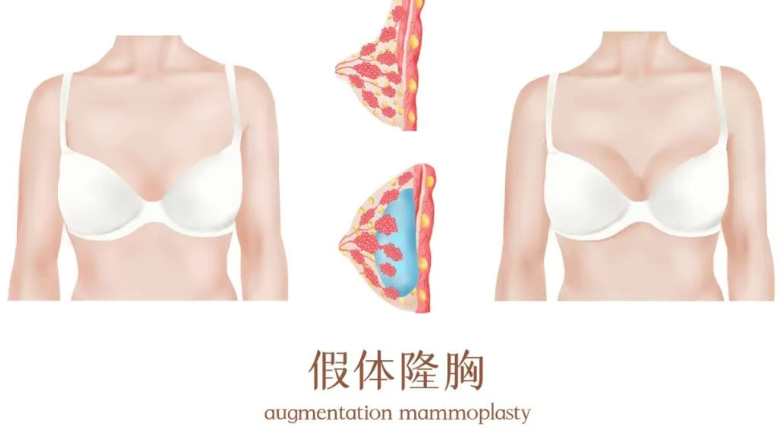 蘇州美萊隆胸技術(shù)的細(xì)節(jié)把控：如何規(guī)避大小不一等常見問題