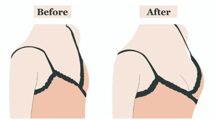 蘇州美萊假體隆胸的假體選擇邏輯：從材質(zhì)到型號(hào)的適配方案