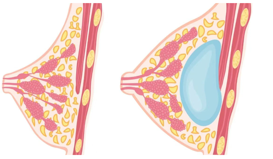 蘇州美萊隆胸術(shù)后療效真實(shí)測(cè)評(píng)：變好期與長期穩(wěn)定性解析
