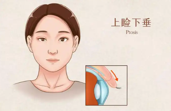 雙眼皮修復就診全攻略：從面診到術后護理