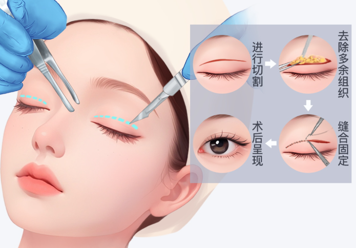 雙眼皮修復醫(yī)生橫向對比：
