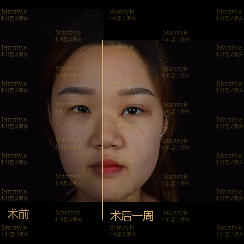 福州美莱华美双眼皮医生测评：吴正思和王明海谁做的好看？价格对比